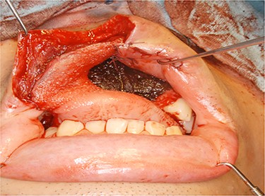 Operative finding. Intraoral defect was filled with a tongue flap.