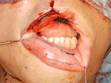 Operative finding. Lower lip musculomucosal flap of 10-mm width was designed at lip mucosa reaching the left side beyond the center of the lip.