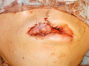 Operative finding. Vermillion border was restored using a lower lip musculomucosal flap.