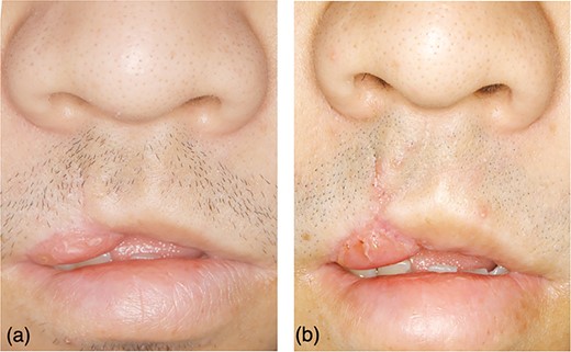 The secondary operation to correct the misalignment of cupid’s bow and remove the contraction. (a) Three months after primary surgery, cupid’s bow was conspicuous for a gap, and the tongue flap became contracted. (b) Collection of cupid’s bow using Z-plasty of white lip and reduction of tongue flap.