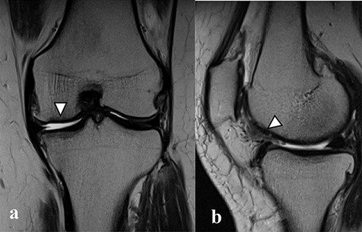 There were cartilage defects (arrowhead) in the medial femoral condyle and trochlea of the left knee (a, b).