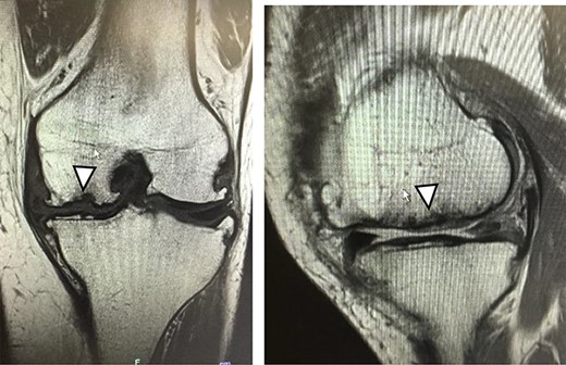 Five years after JACC. MRI showed the graft area was thicker than the surrounding healthy cartilage (arrowhead).