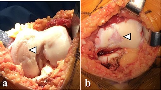 Articular cartilage injury was shown in the medial femoral condyle (arrowhead) (2.5 × 3.5 cm; Outerbridge classification, Grade III) and trochlea (arrowhead) (1.3 × 1.7 cm; Outerbridge classification, Grade III) (a, b).