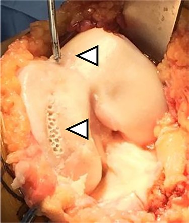 The microfracture was performed using a 4-mm power pick at the cartilage defect (arrowhead).