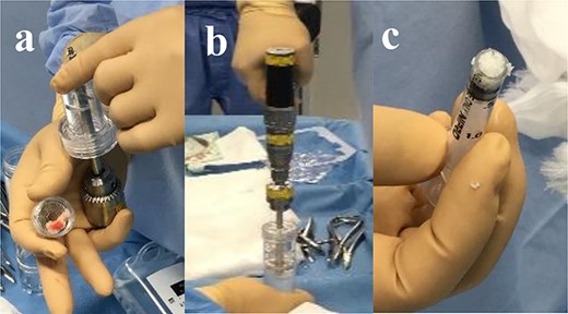 (a) Harvested cartilage fragments were loaded directly onto the Reveille CP. (b) The tissue was morselized in a sterile saline with the drill speed at 1500 rpm for 2 minutes. (c) The collected (?) volume was measured using a syringe marked at every 0.1-ml increment.
