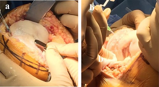 The grafted cartilage particulates at the lesion were compressed, and the bone glue was applied over the particulated tissue (a, b).