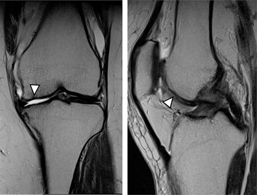 MRI showed cartilage injury of the medial femoral condyle (arrowhead).