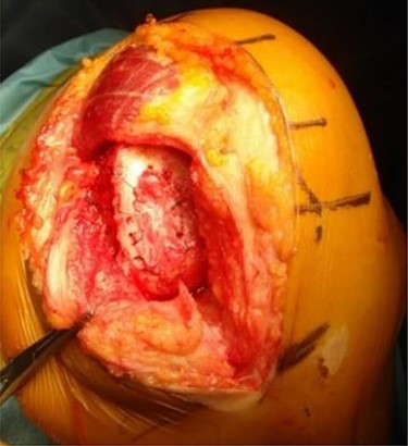 The two-stage implantation of tissue-engineered cartilage-like tissue (JACC) for the cartilage injury of the medial femoral condyle of the left knee was performed and then covered with periosteum taken from the tibia.