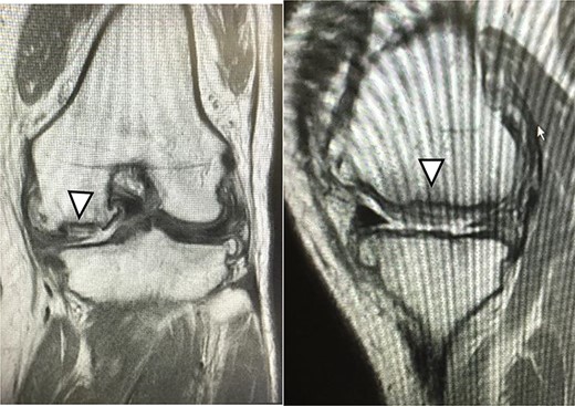 One year after JACC, MRI showed T2 high intensity area in the graft area (arrowhead).
