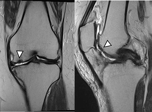 One year after Reveille CP. The graft area was thicker than surrounding healthy cartilage (arrowhead).