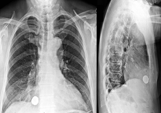 Initial anteroposterior and lateral chest X-rays of the patient, consistent with intrathoracic penetration of the bean bag foreign body.