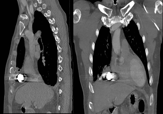 Representative coronal and sagittal images of the patient’s initial chest CT scan confirming the intrathoracic location of the foreign body with associated scatter due to its metallic contents.