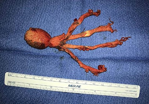 Operative image of the removed intrathoracic bean bag with intact Kevlar coating.