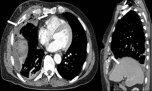 Representative axial and sagittal images from the patient’s CT scan on Day 7 after initial operative intervention. The white arrows on both images show subcutaneous and intrathoracic air, concerning for an empyema.