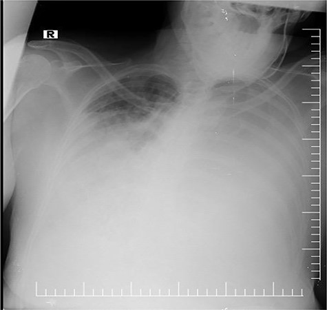 Chest X-ray revealing bilateral opacity in the mediastinum mimicking pulmonary edema.