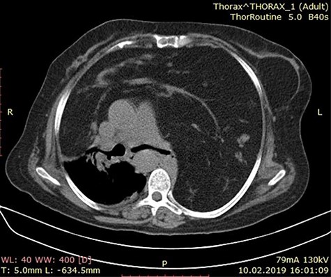 Axial chest CT image showing a mass lesion with wide range of fat density filling both hemithorax was observed, including linear and nodular densities in the right hemithorax. A dense retrosternal mass displacing both lungs and chest. No evidence of invasion is seen.