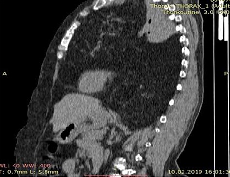 CT scan of the chest showing a large anterior mediastinum mass projecting to the right and left hemithorax with wide range of fat tissue density.