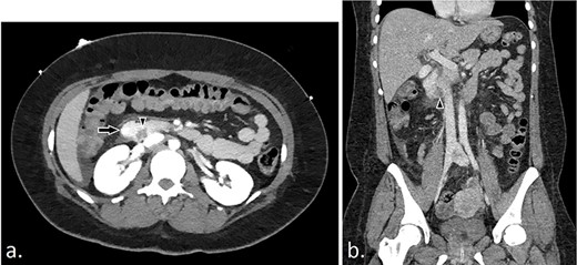 (a and b): CT angiography with axial and coronal views demonstrating intraluminal duodenal hemorrhage (arrow) and hemorrhagic duodenal mass (arrowhead).