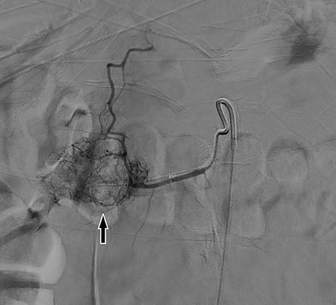 Digital subtraction angiography demonstrating large inferior pancreaticoduodenal arcade with superior reconstitution of the gastroduodenal artery and common hepatic artery and represents region of mass in without active contrast extravasation.