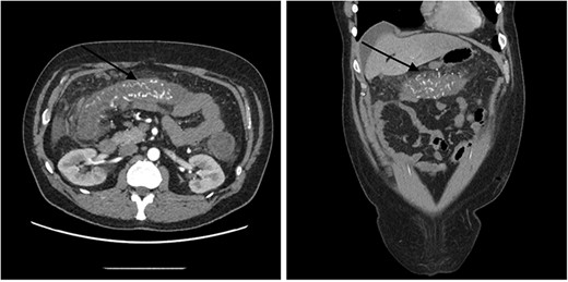 Contrast-enhanced abdominal CT images of superior mesenteric AVM causing acute congestive ischaemic colitis affecting transverse colon.