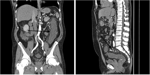 Contrast-enhanced abdominal CT images of inferior mesenteric AVM causing acute congestive ischaemic colitis affecting descending and sigmoid colon, and rectum.