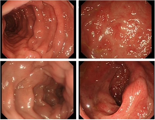 Flexible sigmoidoscopy images showing engorged erythematous appearance of the colonic mucosa. No ulcerations, polyps or blood was found.