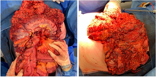 Intraoperative findings of bluish discolouration of transverse colon and extensive varicosities.