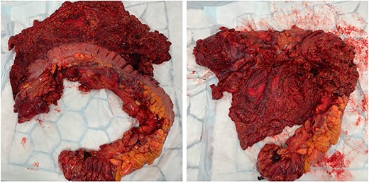 Intraoperative findings of oedematous appendices epiploicae and mesocolon.