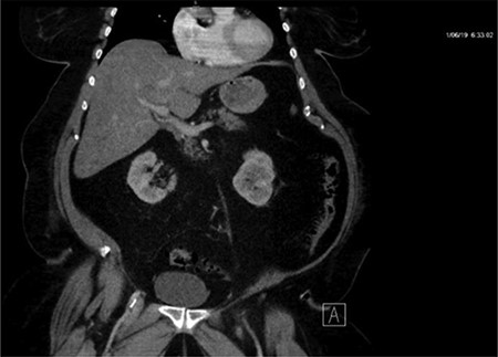CT with IV contrast taken at 0633 which shows ill defined, hypo-enhanced lesions of the liver.