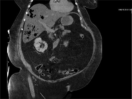 Repeat imaging taken 13.5 h later which depicts many air bubbles in the liver parenchyma.