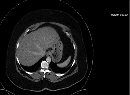 CT with IV contrast taken at 0633 which shows ill defined, hypo-enhanced lesions of the liver.