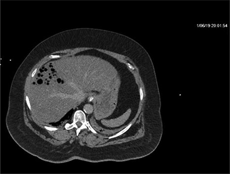 Repeat imaging taken 13.5 h later which depicts many air bubbles in the liver parenchyma.