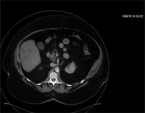 CT with IV contrast taken at 0633 which shows ill defined, hypo-enhanced lesions of the liver.