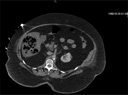 Repeat imaging taken 13.5 h later which depicts many air bubbles in the liver parenchyma.