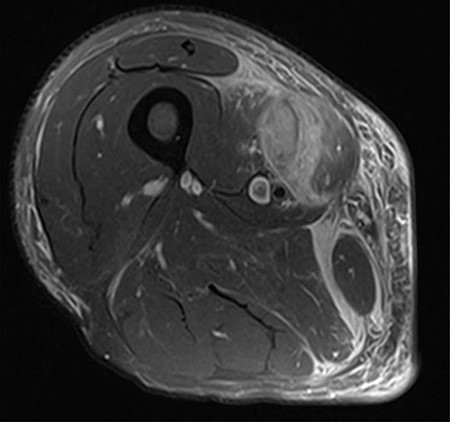 MRI axial view of right thigh region showing hematoma.