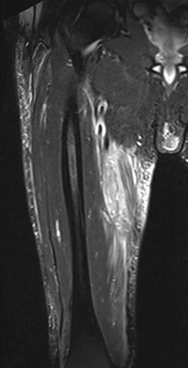 MRI sagittal view manifesting hematoma in right thigh region.