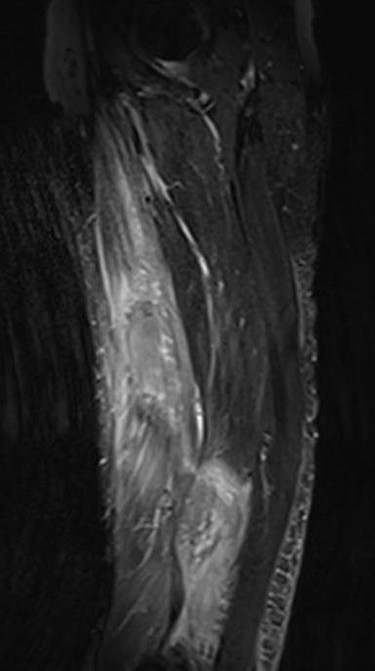 MRI coronal view displaying hematoma and rupture of sartorius muscle.