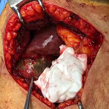 Intra-operative photo.