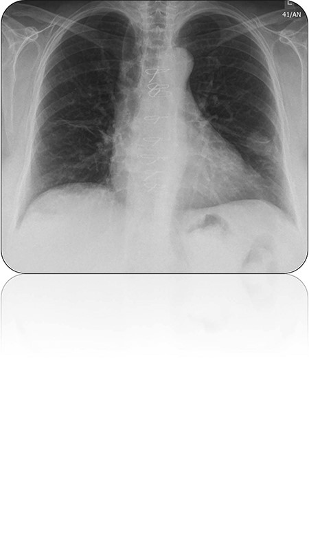 Chest radiograph demonstrating left lower lobe lesion.