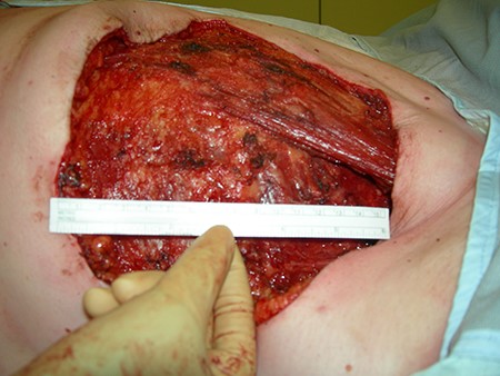 Mastectomy.