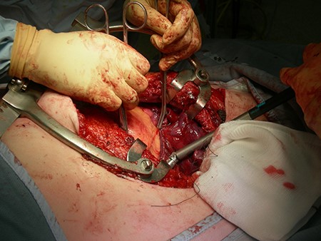 Thoracotomy through the original mastectomy incision.