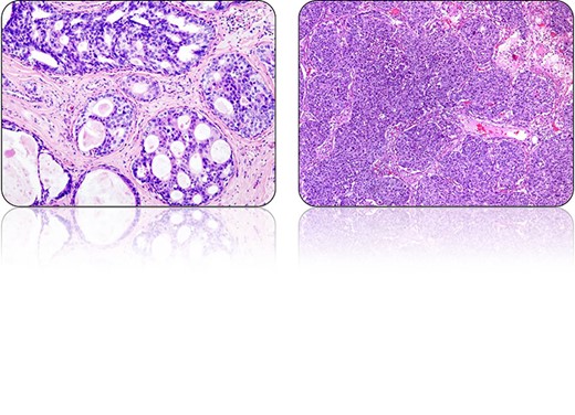 The characteristic histological appearances of (left) DCIS and (right) lung adenocarcinoma.