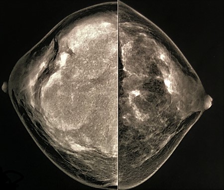 Mammogram (CC view) performed 2 years ago had shown lobulated mass with smooth and circumscribed margins.