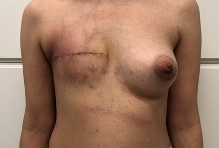 Two days after mastectomy and breast reconstruction with tissue expander.