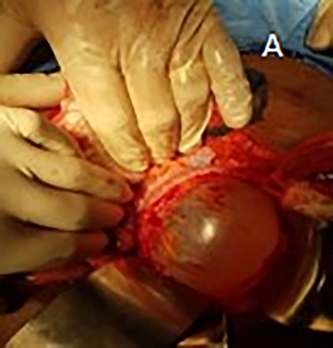 (A) presence of cystic mass located in the sigmoid colon mesentery.