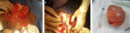 (A) Exposure of cystic mass after Mattox maneuver. (B) Blunt dissection without mesocolon devascularization. (C) Surgical piece completely resected.