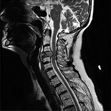 Sagittal view of C4 lesion.