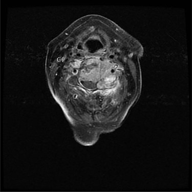 Axial view of C4 tumor showing encasement of left vertebral artery.