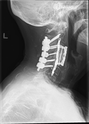 Postoperative lateral films.