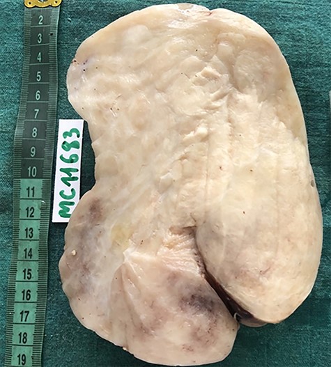 Approximately, the mass measured 15-cm-long axis showing well demarcated tumor without veritable capsule. The cut surface appears yellowish white and homogeneous with no hemorrhage or necrosis.